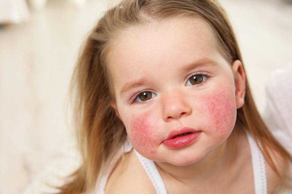 Atopijski dermatitis 1 Atopijski Dermattis