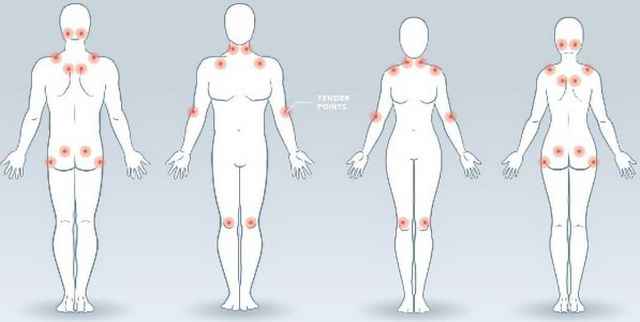 Fibromialgija 1 Fibromialgija zdravljenje Reha Medical